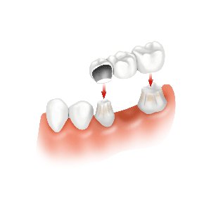 dental-bridge